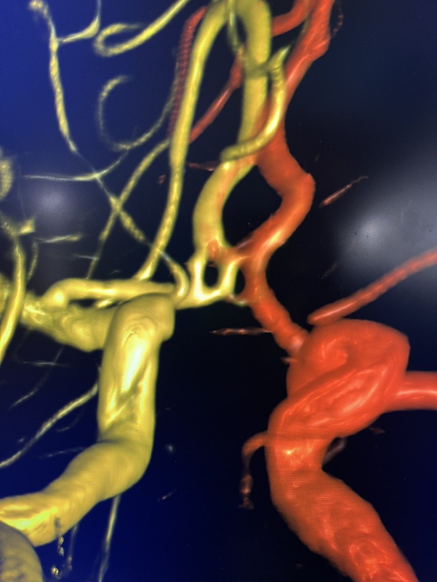 Drake developed the fenestrated clip out of necessity. What if nature gave us the next 💡? Check out this ACoA double fenestration. Can you think of a scenario that would require a double fenestration clip? @cvsection @SiemensHealth @PennNSG @visishs @Drkandregula #SuperDyna