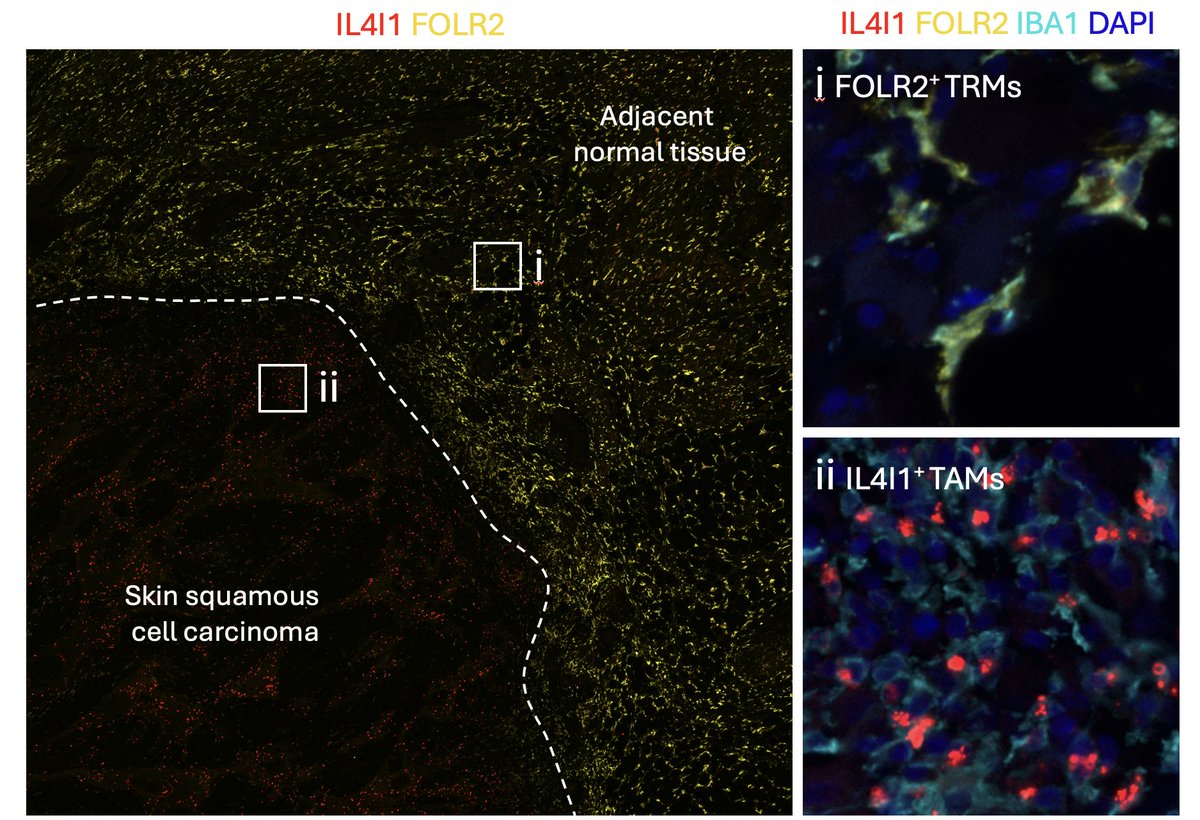 MagdaMatusiak's tweet photo. The big news since the @biorxivpreprint- spatial segregation of FOLR2 tissue-resident and IL4I1 tumor-associated macrophages is #conserved across 10 human #tumors: breast, colon, lung, stomach, pancreas, bladder, skin, larynx, esophagus, oral mucosa. https://t.co/q0ILmx06s7