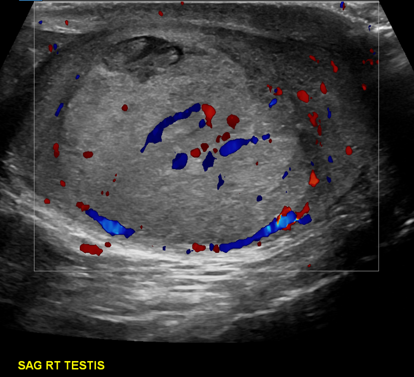 40 year old presents with acute pain, diagnosed with mild epididymitis (images not shown). Best diagnosis of the intratesticular finding? Answers by GIF only (or poll below!) #FOAMed #ultrasound
