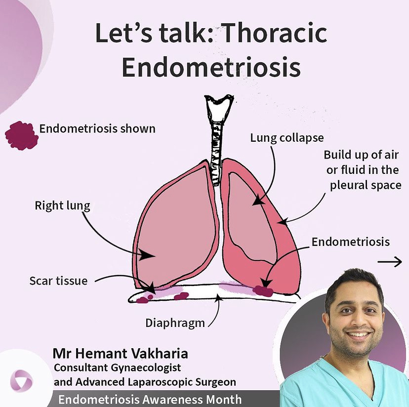 LondonGynae's tweet photo. 1/2 What is Thoracic Endometriosis? LG’s Mr Hemant Vakharia, spoke recently to New Magazine to share expertise and helpful insight about Thoracic Endometriosis.

Swipe for insight regarding complications of this along with treatment options. https://t.co/02bjnw2sv2