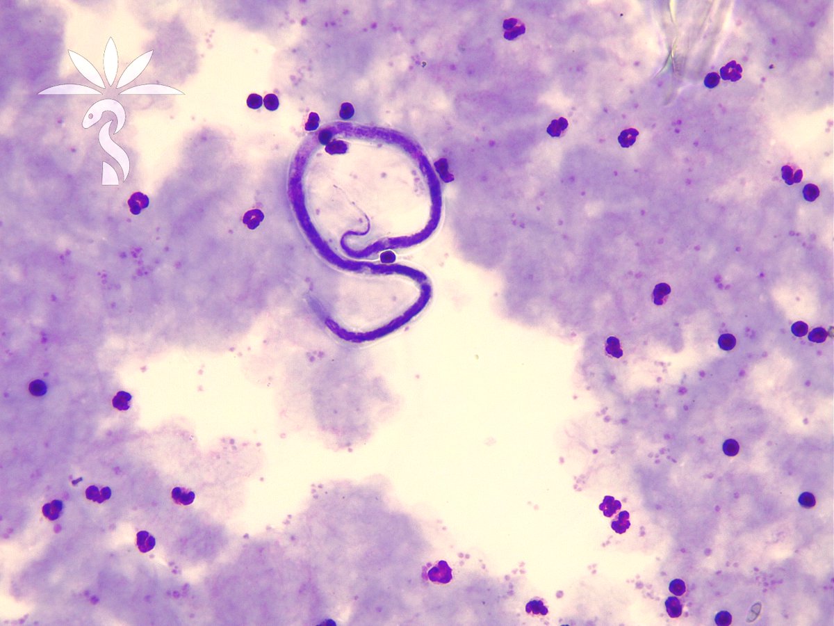 It’s time for more microfilariae with Idzi Potters and @ITMantwerp!The patient is from Alor Island, Indonesia. The microfilariae are ~305-315 µm on Giemsa thick film. parasitewonders.blogspot.com/2024/04/parasi… Identification? #mayopath #pathology #CrittersOnTwitter #PathBugs