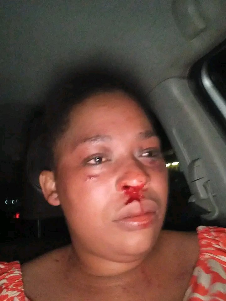 Thandeka was allegedly brutally Beaten by her boyfriend, who is a police officer who works at Mpumalanga police station in Hammardale, she didn't get help to open a case. She is seeking justice.