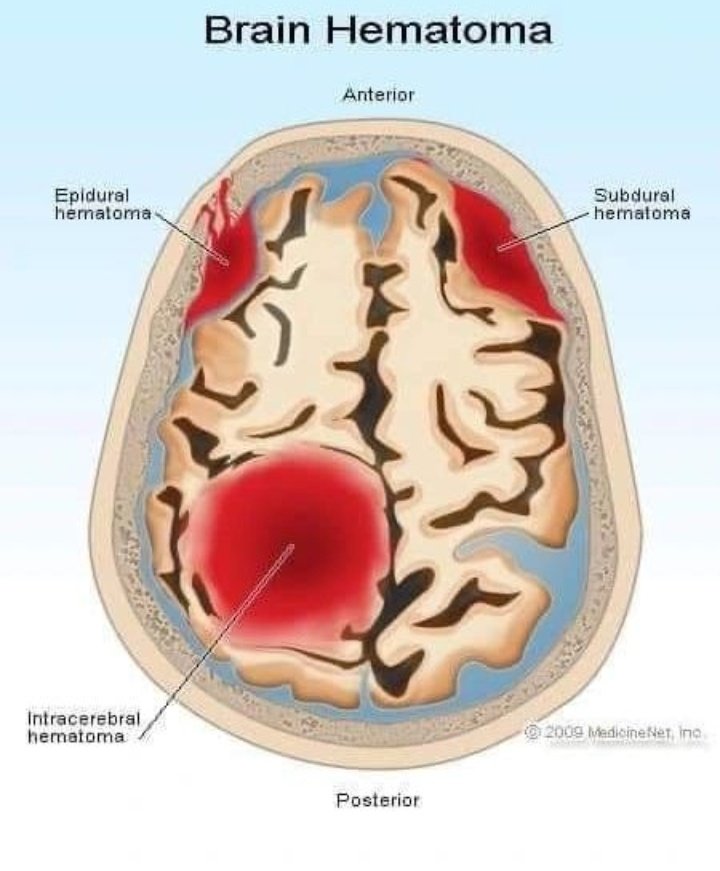 drusamajahangir's tweet photo. 🧠 Brain Hematoma 🩸

#MedKnowledge https://t.co/cCRhn0uMS0