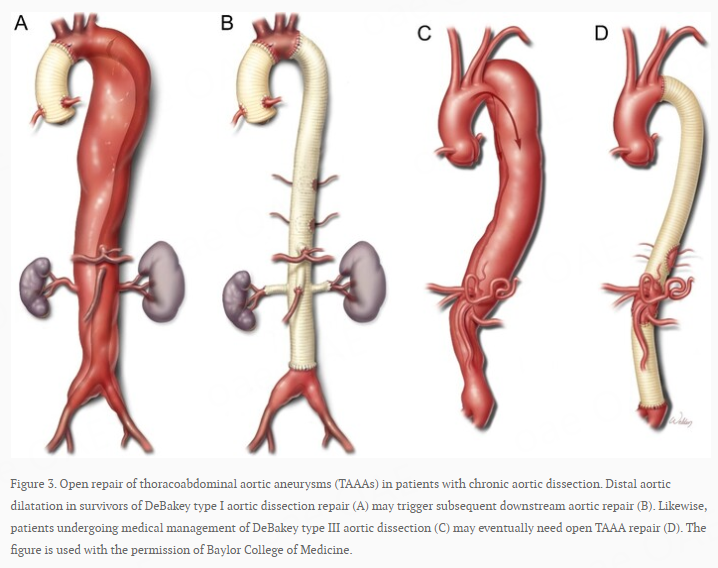 🔥🔥#OpenRepair for #ThoracoabdominalAorticAneurysms precipitated by #ChronicAorticDissection

Authors: Pro.f Joseph S. Coselli @JCoselli_MD and Dr. Jonathan C. Hong @chaz_hong

🔗Full text:f.oaes.cc/xmlpdf/6c9b9eb…