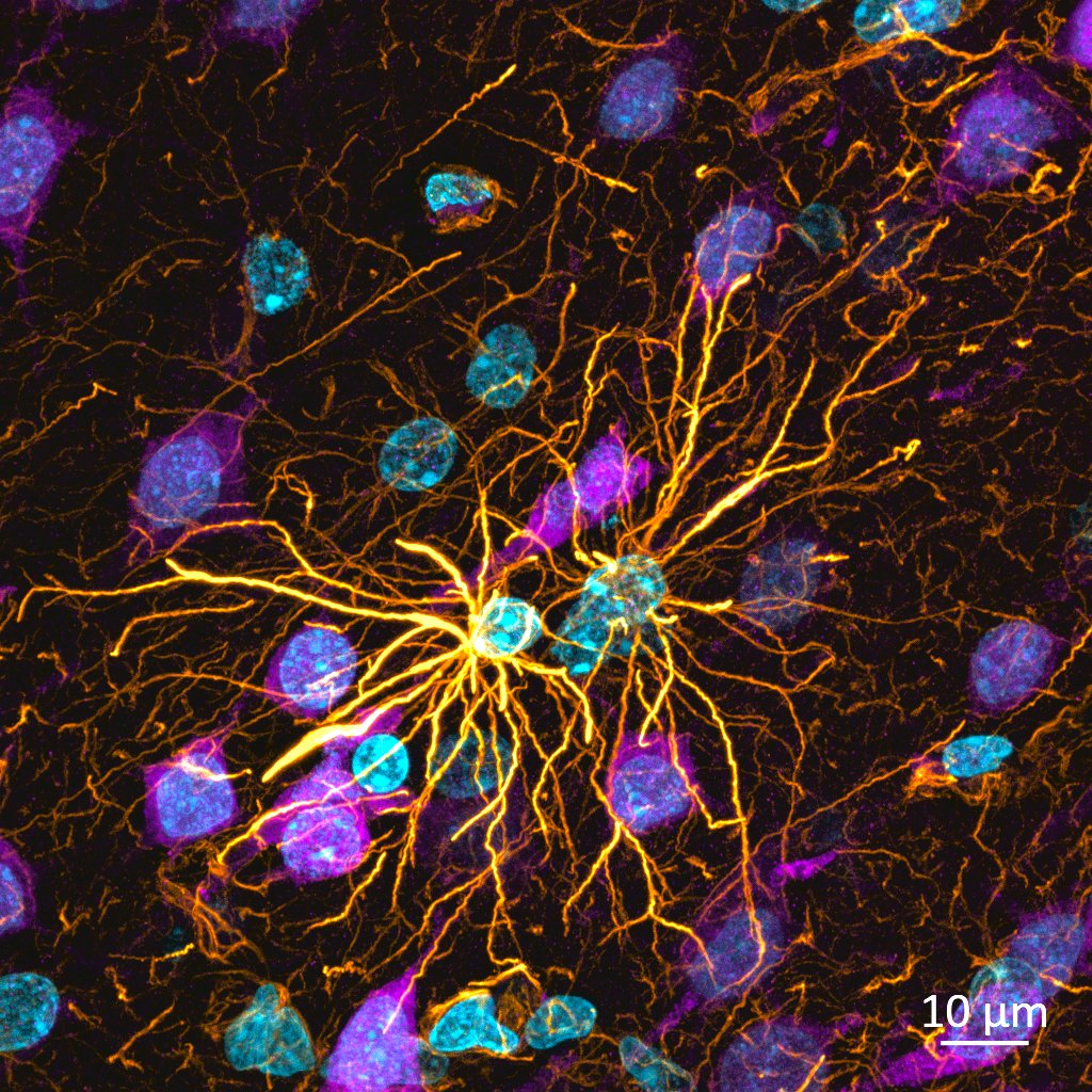 Two very angry #astrocytes attacking some neurons to start the week! Staining 🔬: neurons (🟣Neun), astrocytes (🟡 Gfap), nuclei (🔵 Dapi) @zeiss_micro #MicroscopyMonday