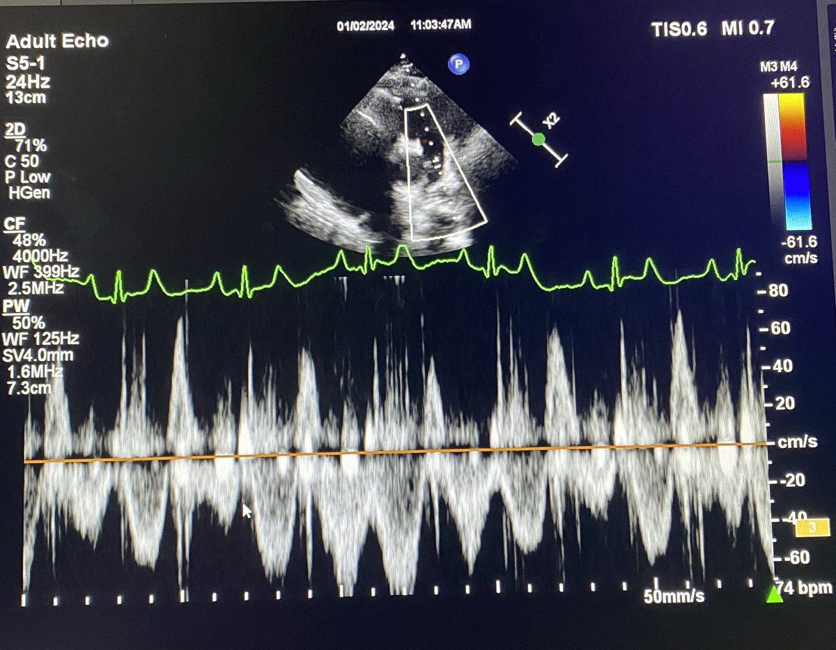 Doppler For fellows. Pulmonary Doppler of a 56 yr old female with right heart failure due to EMF and fibrosed calcified small RV. What is the “physiology” called?