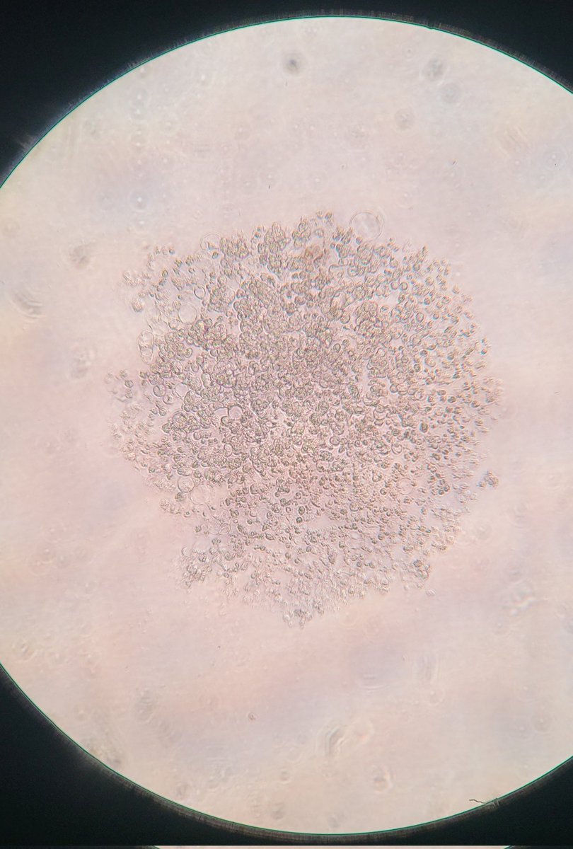 Cancer ball, OVCAR-3 cell line
Forms loose aggregates in 3D culture rather than compact spheroids like the OVCAR-8 cell line

Two different ovarian cancer cell lines, variances