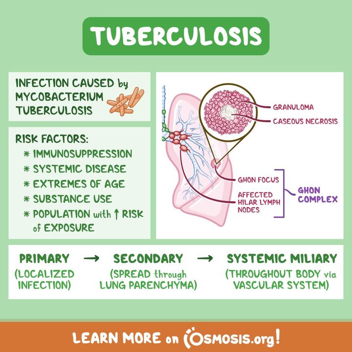 OsmosisMed's tweet photo. The results are in... the 2024 March Madness Deadliest Diagnosis, according to you learners who voted in our brackets, is tuberculosis! ☠️ Dive into our special #PathologyReview to find out how tuberculosis won its terrible title.
Learn more: https://t.co/Fcmw9e4xsX https://t.co/zO1iL2Ot55