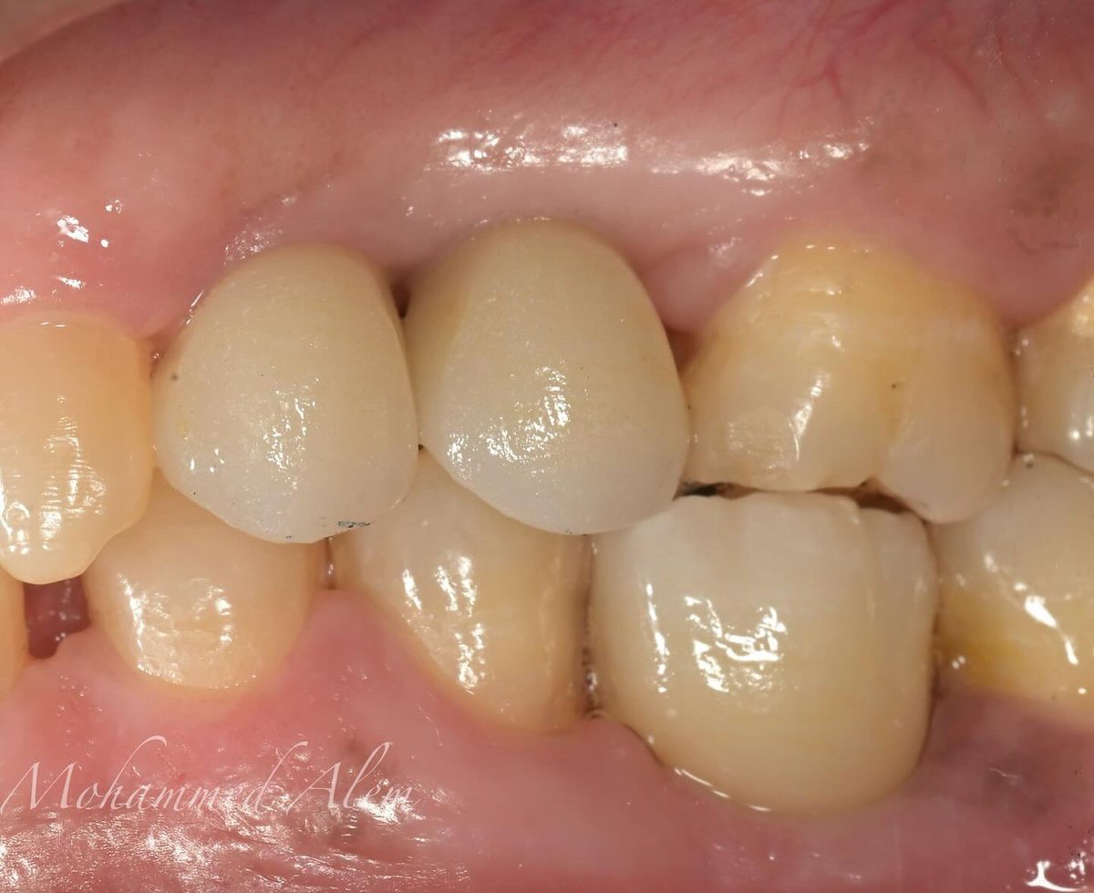 3 Screw-retained Implant crowns to replace #15,14,46.
Right quadrants Done, Left quadrants coming soon!