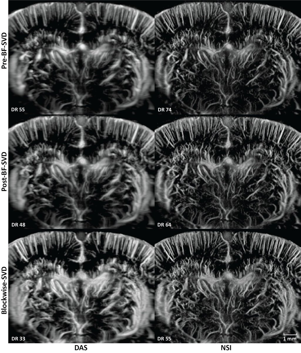 Excited to share our latest publication in IEEE Transactions on Medical Imaging. We further developed Null Subtraction Imaging (NSI) to enable high-resolution ultrafast power Doppler imaging in a computationally inexpensive way. The paper is open access!
ieeexplore.ieee.org/document/10486…