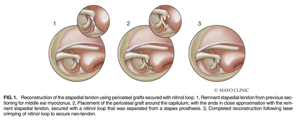 Can the stapedial tendon and tensor tympani be reconstructed to treat postoperative hyperacusis following tendon lysis? Click to read more: bit.ly/3J3SoZs #MayoClinicENTResearch #DrKarlKhandalavala #DrJamesDornhoffer @PolingGayla #DrColinDriscoll