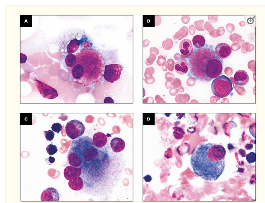 #Hemepath pitfall alert! Thrombopoietin-mimetic agents such as eltrombopag (Promacta) &amp; romiplostim (Nplate) cause changes in megakaryocytes that exactly mimic MDS/MPNs. The paper below describes some abnormal forms, but I've seen the whole gamut. Be wary!
ncbi.nlm.nih.gov/pmc/articles/P…
