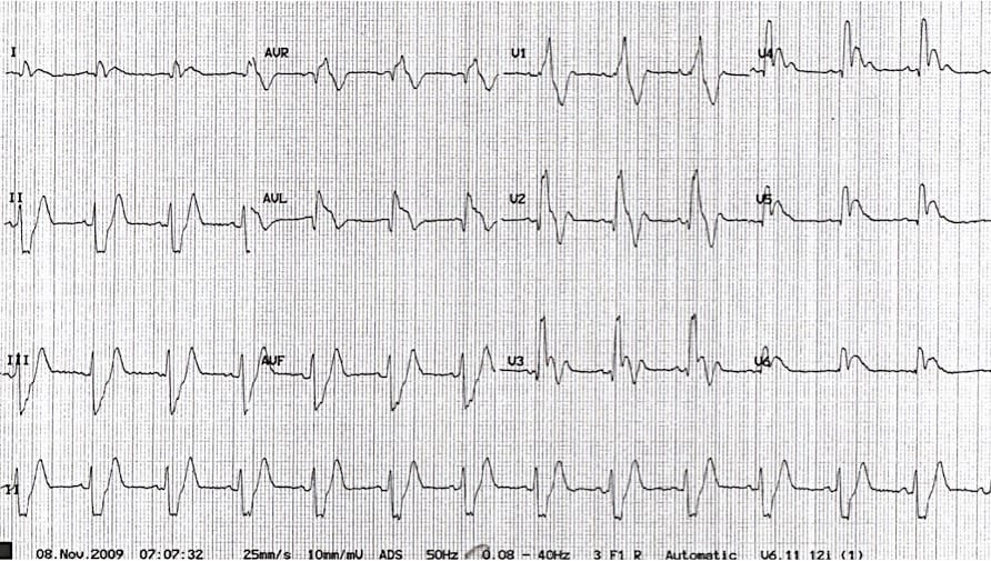 23-year-old with syncope, severe distress, and a cryptic ECG. A race against time to uncover a deadly diagnosis. Can you spot the clues to a massive PE? Dive in and decode the mystery. litfl.com/electrocardiog… #MedEd #FOAMed #CardioTwitter
