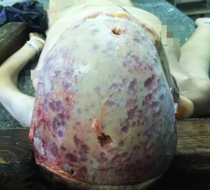 schowardjd's tweet photo. Here's how the lytic or punched-out lesions appear in multiple myeloma on autopsy and imaging.

( Not the same patient ) https://t.co/VLafLIgp3V