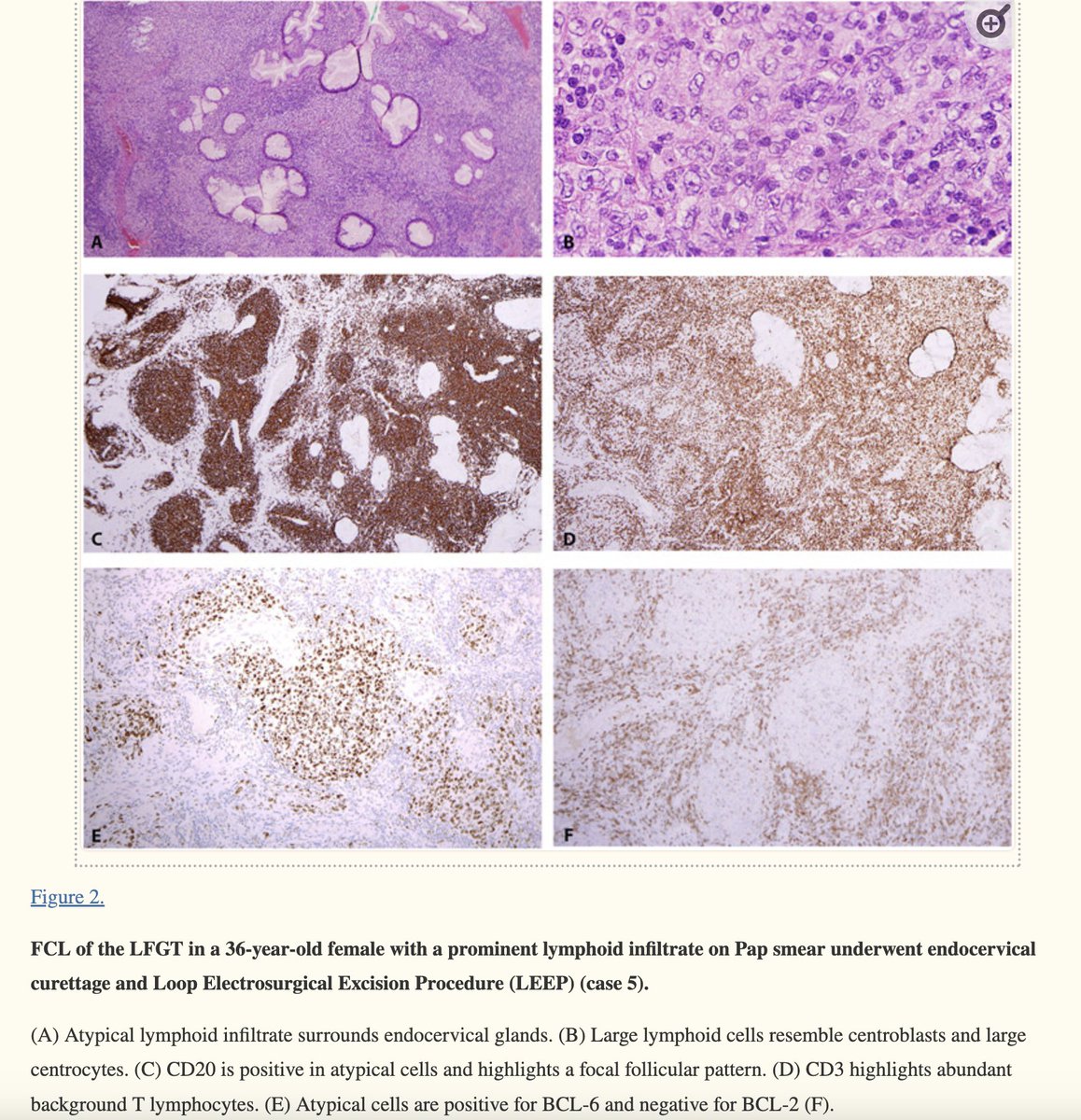 Follicle center lymphoma of the lower female genital tract: 🩸Typically localized disease with no evidence of bone marrow involvement 🩸Most cases show a follicular pattern, at least focally 🩸Large centrocytes may be a prominent feature, leading to concern for diffuse…