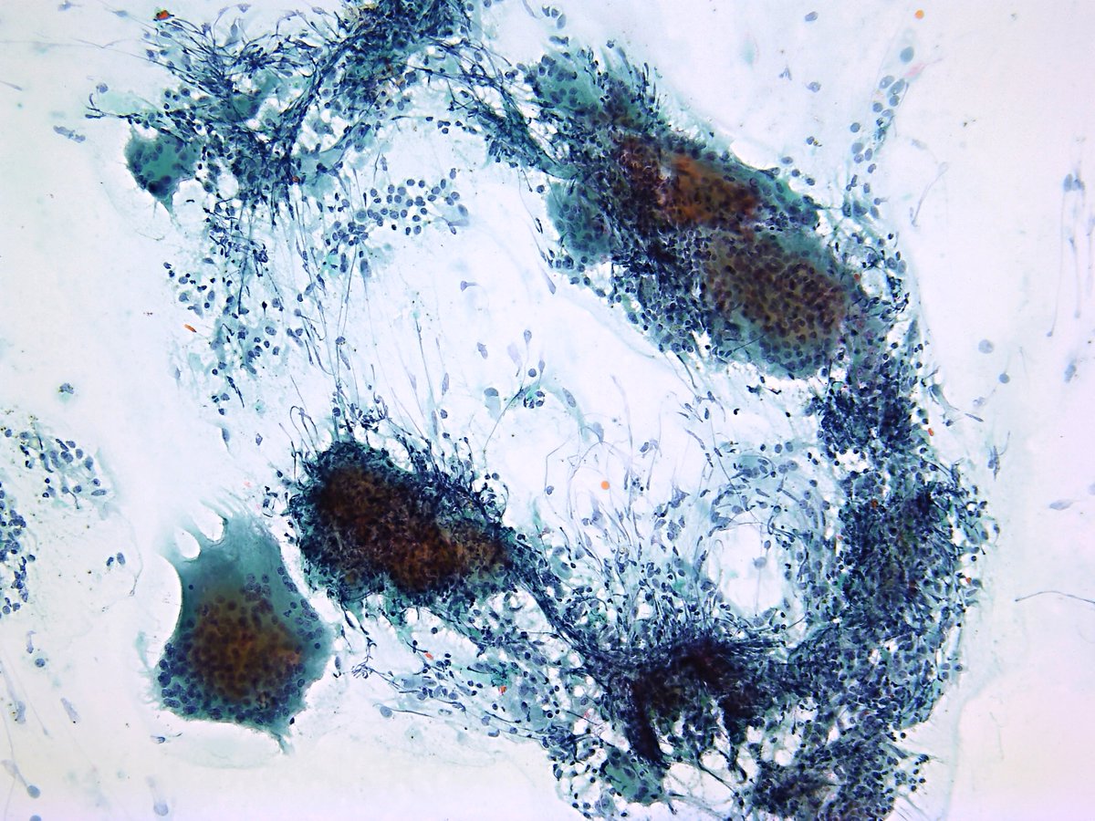 Patholwalker's tweet image. Subacute thyroiditis. Thyroid, FNA. #Pathology #Pathologist #FNAPath #CytoPath #EndPath