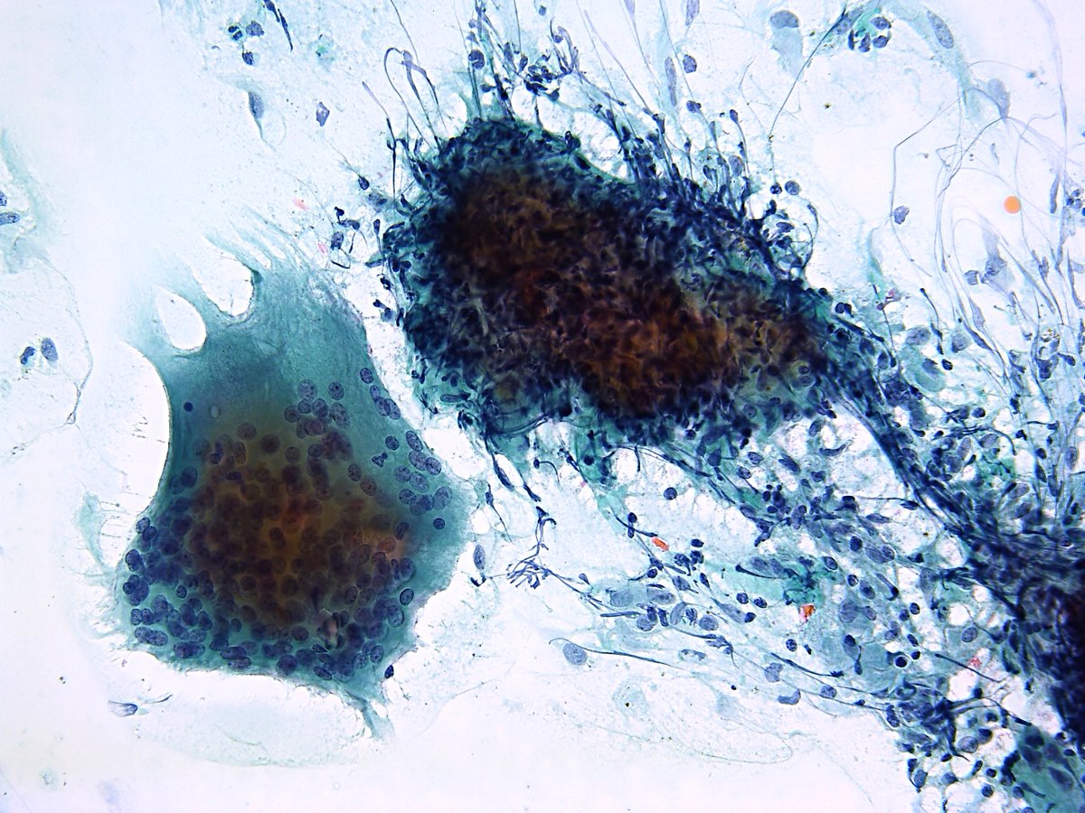 Patholwalker's tweet image. Subacute thyroiditis. Thyroid, FNA. #Pathology #Pathologist #FNAPath #CytoPath #EndPath