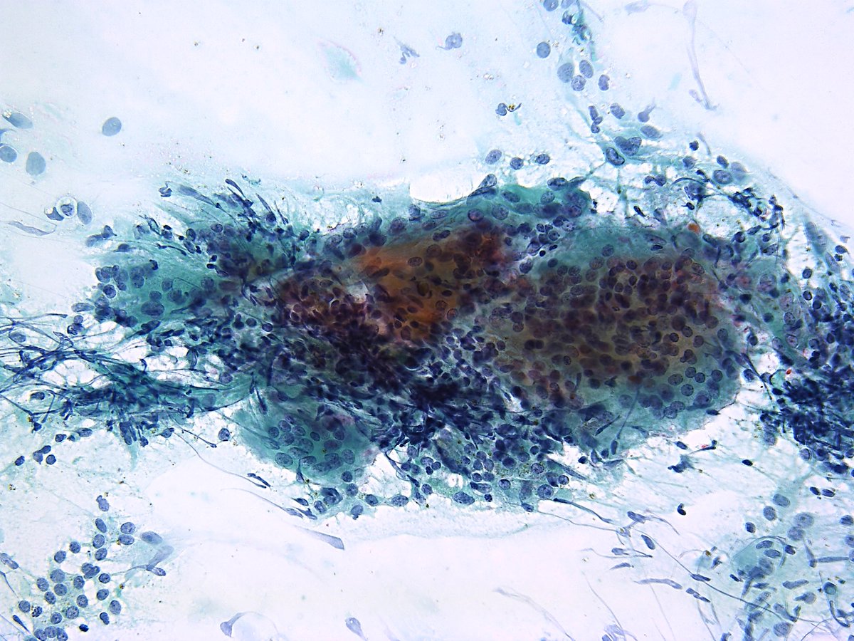 Patholwalker's tweet image. Subacute thyroiditis. Thyroid, FNA. #Pathology #Pathologist #FNAPath #CytoPath #EndPath