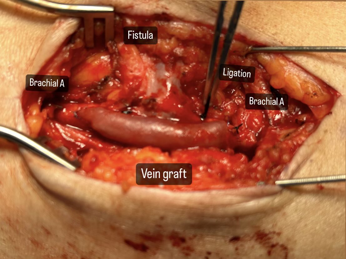 #vascularsurgery Residents and fellows, what is the operation depicted here and what is it’s indication?