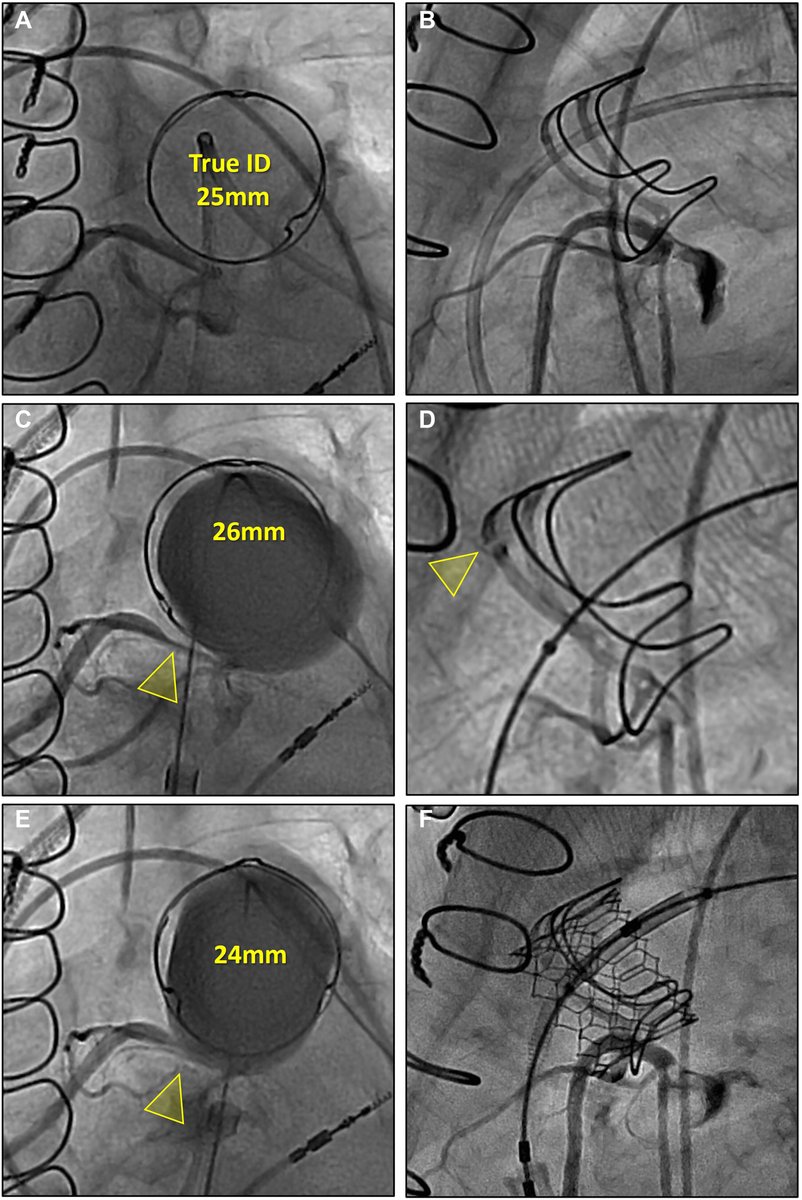 Images In Intervention: Data demonstrating the need for coronary artery compression testing during ViV #TPVR procedures when the coronary arteries are in close proximity to the BPV ring. bit.ly/48dE3Ur #JACCINT