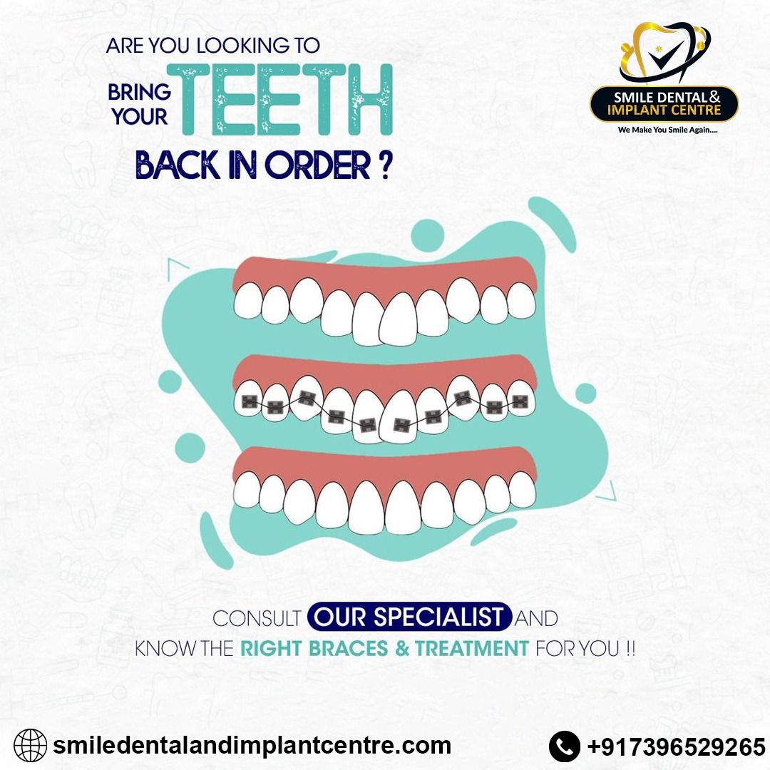 Are You Looking to Bring Your #Teeth Back in Order? Consult our Specialist and know the Right #BracesTreatment for You! Visit #SmileDentalandImplantCentre Now.

👉 For an Appointment call us at +91-7396529265
#braces #orthodontics #invisalign #dentist #orthodontist #dental