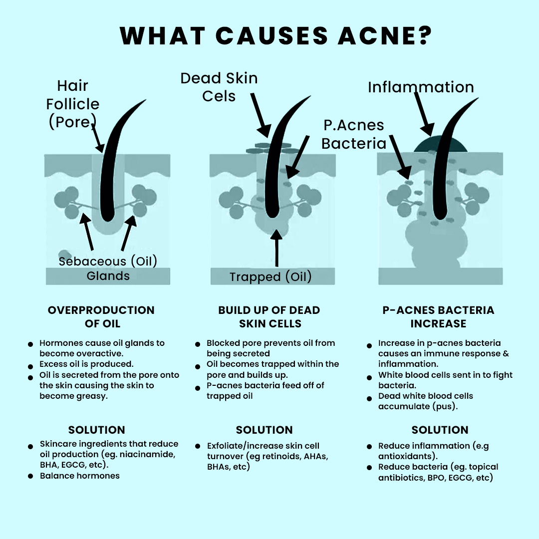 😊Today, we're going to talk about a common skin issue that affects many of us - acne. Acne can be a real pain, both literally and figuratively, but don't worry, we've got you covered!
#AcneAwareness #SkincareTips #SkinCare #HealthySkin #Acne #Wellness #skincarebloggers #Jupiven