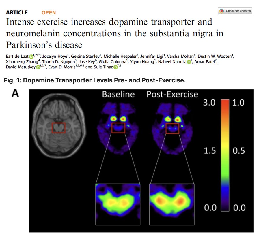 Does exercise slow Parkinson's disease progression?Check out what happened to the dopamine transporter levels pre- and post 6 month intense exercise. Thanks @lvolpic for sharing this study from de Laat and colleagues in @Nature_NPJ @Nature Key Points: - The authors employed…