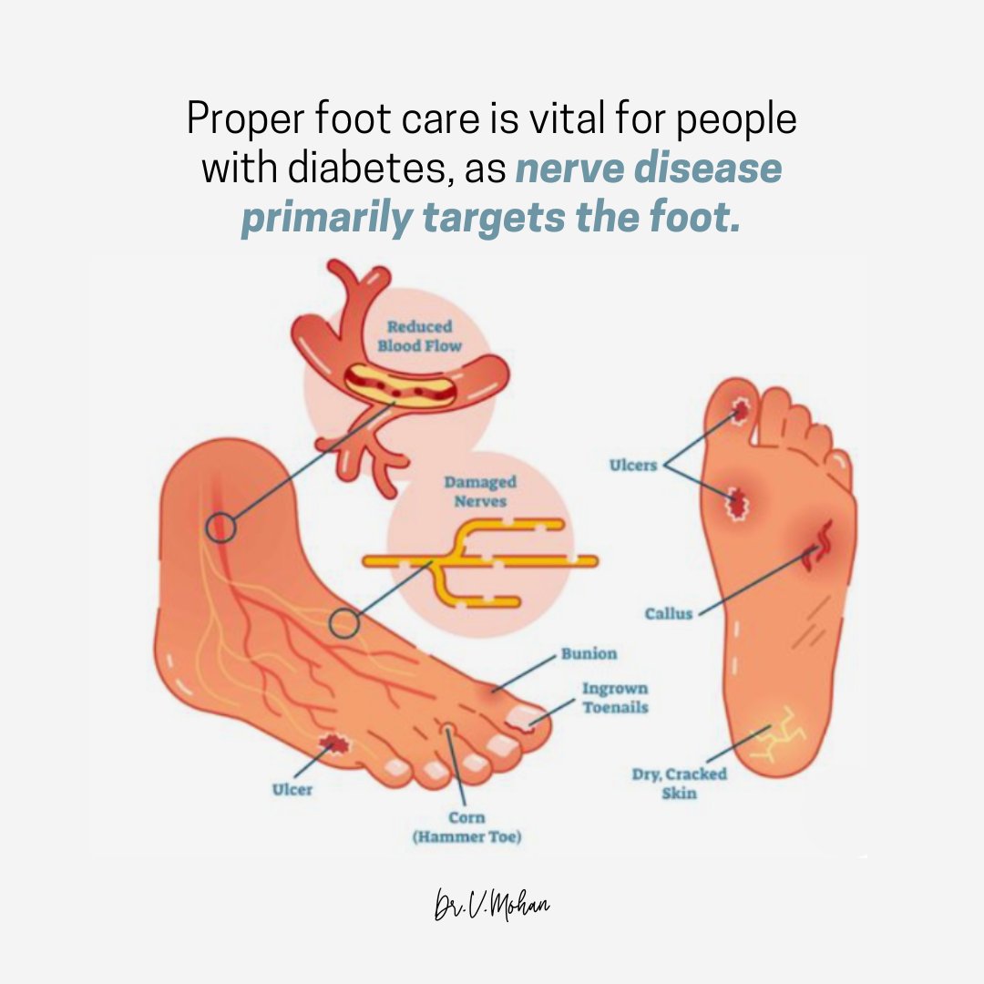 Ensuring foot health is essential, especially for those managing diabetes. Here are some crucial tips for diabetic foot care. * Keep blood glucose under control. * Wash feet everyday and make sure that you dry them thoroughly. Inspect between toes. * Always cut nails straight