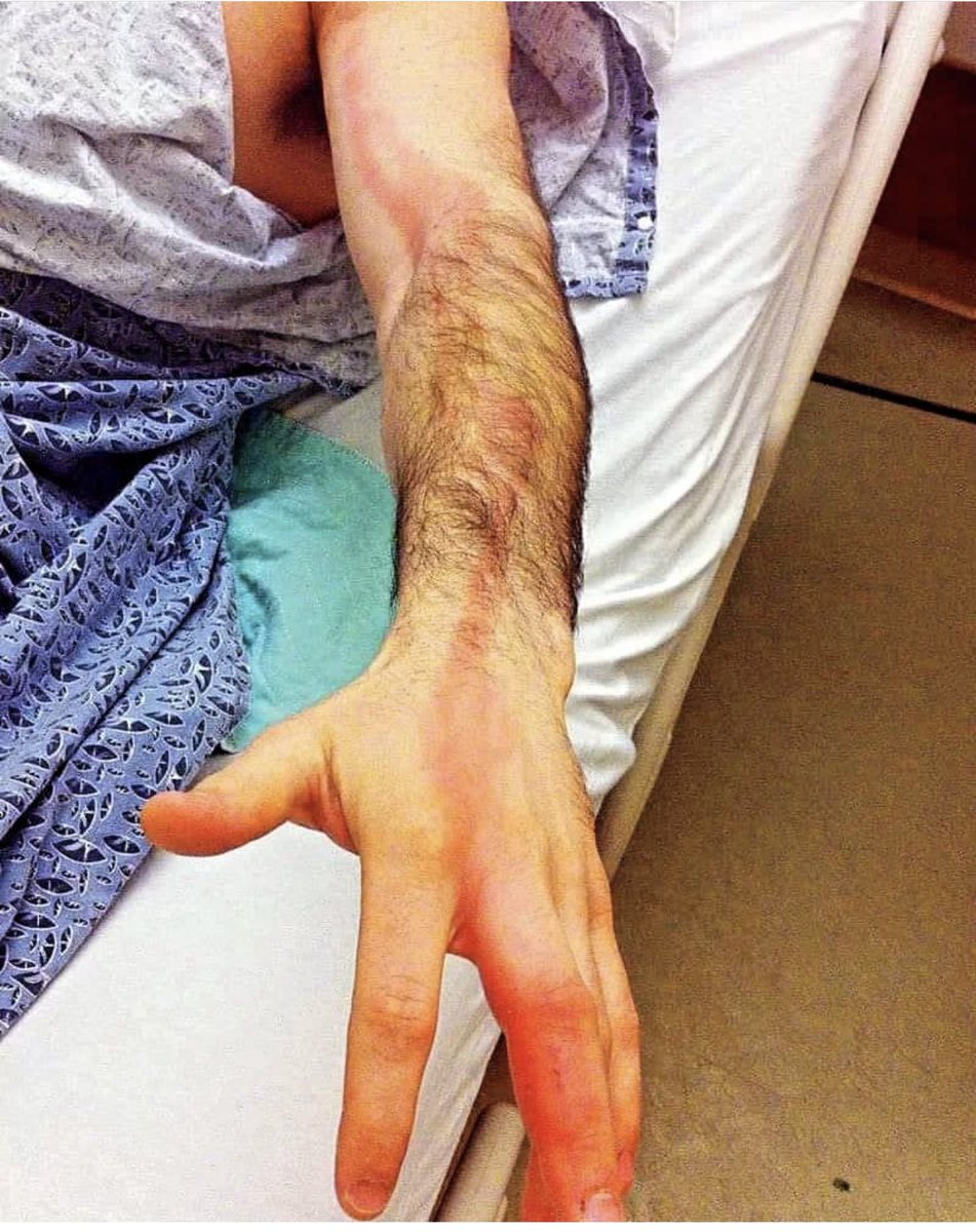 🤕 What's the probable diagnosis for this basketball player?

He has a painful red streak extending from an abrasion on his hand up his forearm.

What's your diagnosis? #MedicalMCQ #SportsInjury