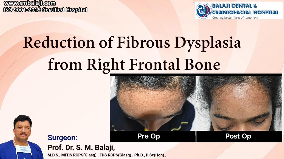 Reduction of Fibrous Dysplasia from Right Frontal Bone 
#FibrousDysplasia #BoneHealth #SurgeryRecovery #MedicalProcedure #HealthcareJourney 
youtu.be/n8Sp4qwu9sY