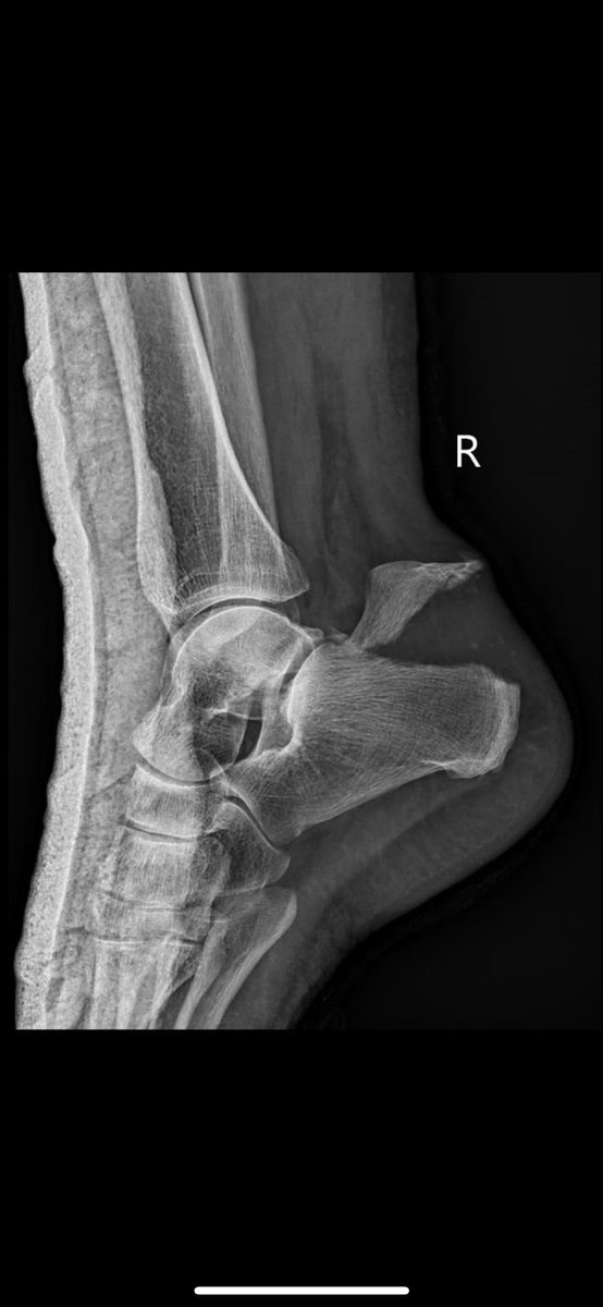 Patient referred from another center for treatment. What do we call this injury pattern? GIF responses are welcome. Suspected mechanism of injury? What treatment would you propose? Share your thoughts! #FOAMed #MedEd
