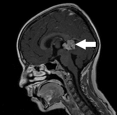 For patients with tumours in the pineal region ⬇️, patients typically present with raised intracranial pressure (headaches and vomiting, usually worse in the morning) and loss of being able to look upward (‘Parinaud’ syndrome) 3/12