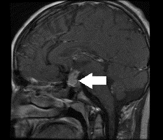 Diagnosis first involves recognising signs & symptoms, depending on the initial site – most commonly in the suprasellar and pineal regions, or both. For suprasellar tumours ⬇️, patients typically present with hormone disturbances e.g. diabetes insipidus or growth failure 2/12