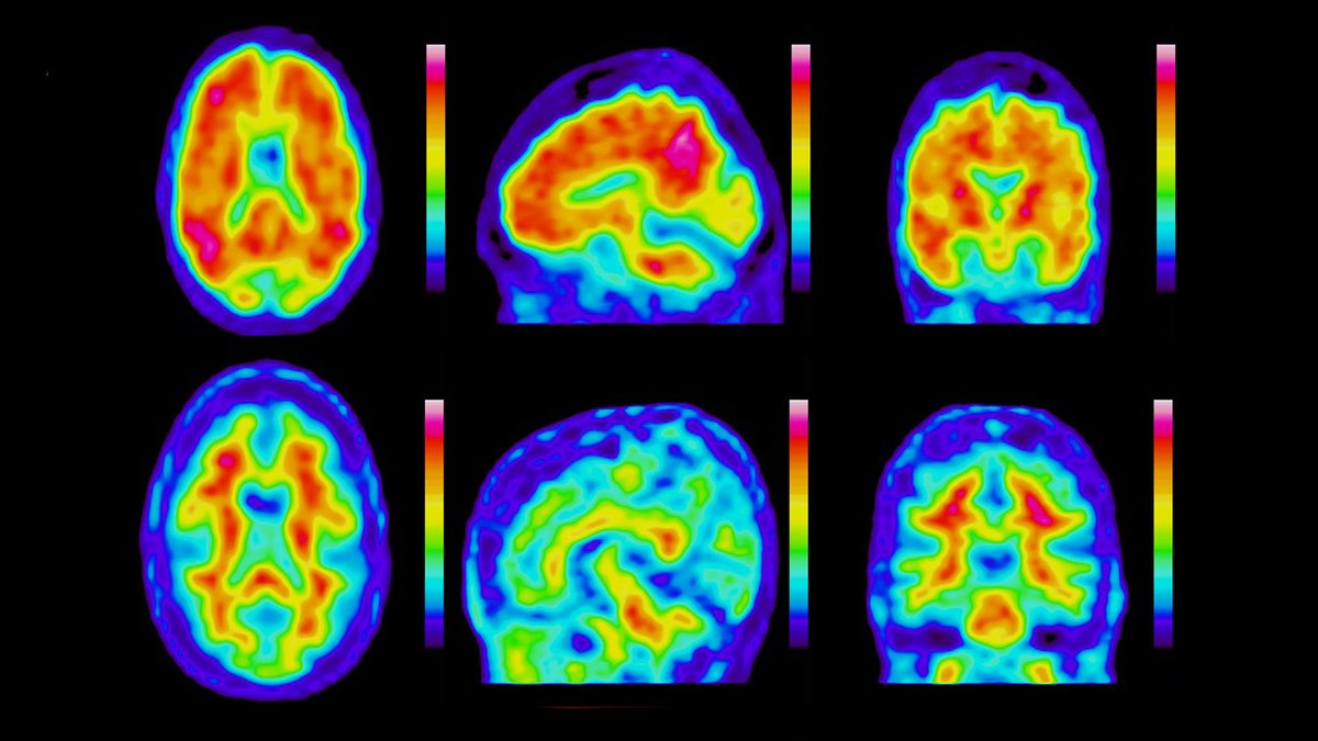 The GIGA-CRC-Human Imaging receives exceptional funding from the ROGER DE SPOELBERCH Foundation for a large-scale project on Alzheimer's disease. @GIGA_ULiege @Giga_CRCivi #Alzheimers #ULiège 👇👇👇👇 news.uliege.be/cms/c_19588323…