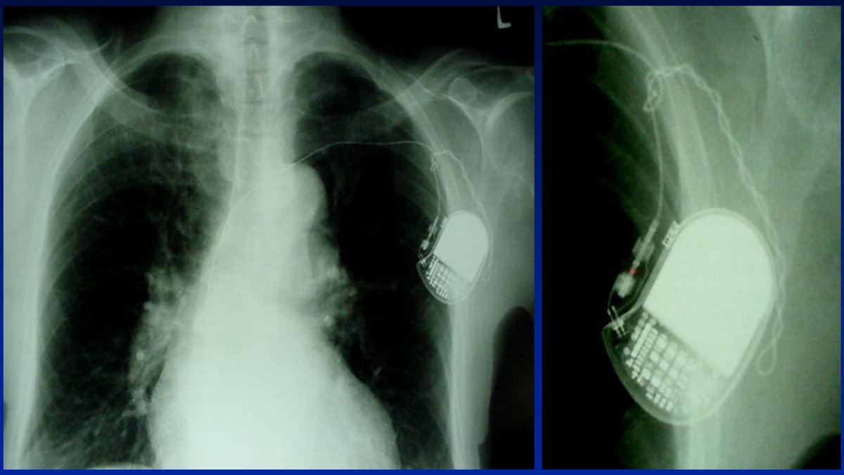 For fellows: pacemaker patient; what is the reason for this complication?