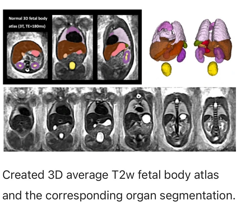 Automated 3D fetal MRI organ volumetry methods *are* feasible for our tiniest patients 🐣and could make more detailed assessment possible. Congrats to leads @AlenaUllaUus @LisaStory18 & fellow coauthors on publishing with @NaturePortfolio See link 📖➡️ rdcu.be/dDmCn