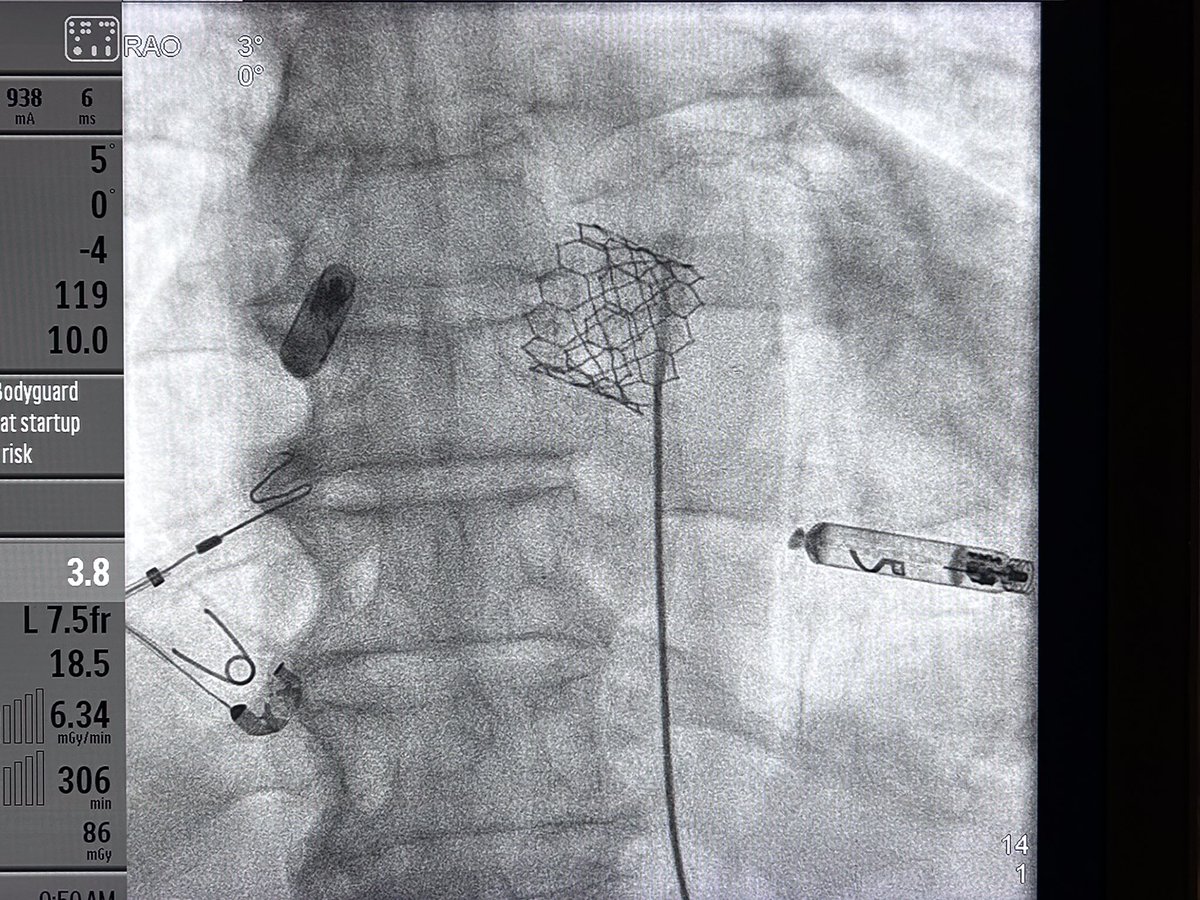 Congratulations to Dr Marc Waase for implanting the first commercial dual chamber leadless pacemaker Aveir, for the Montefiore/Einstein Health System. A step forward to advanced technology @MontefioreNYC @MonteHeart @WPHospital @WaaseMarc @AbbottNews