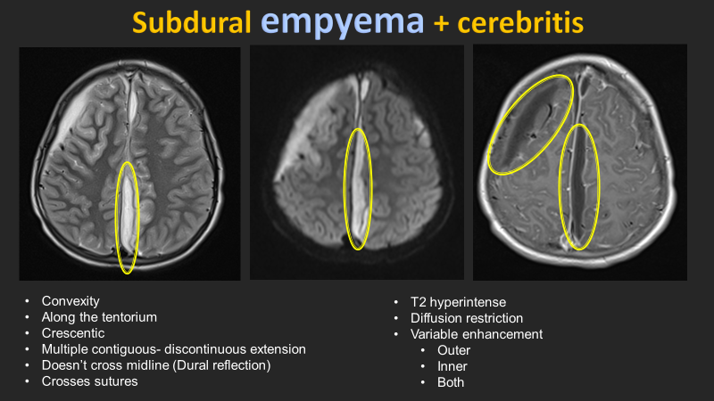 Starting in 3 hours! I will discuss the orbital, intracranial, and craniofacial complications of sinusitis. Register using the provided link by @ESHNRSociety