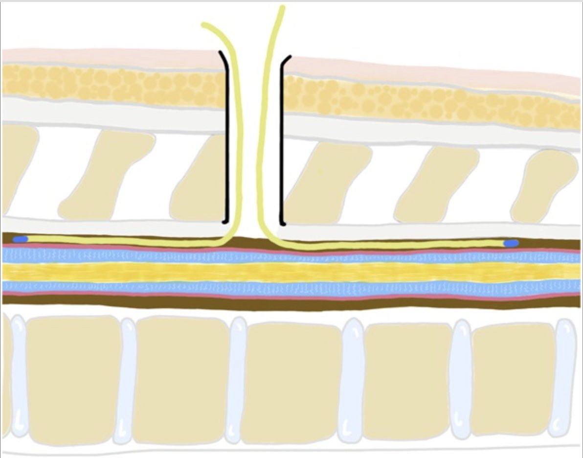 #ONSNew Targeted Epidural Blood Patch Injection Through a Mini-Open Approach for Treatment of Spontaneous Intracranial Hypotension bit.ly/3TV0GJq by Abboud et al @yourUMG @CNS_Update @DKondziolkaCNS