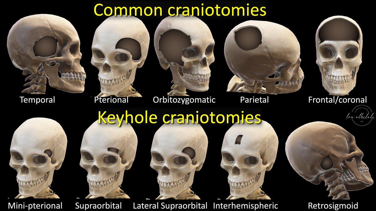Can't remember the types of craniotomies off the top of your head? Do you need another thing to memorize like you need a hole in your head? Here's a quick figure of some common craniotomies to help you out! Want to dig deeper into these holes!? Here's what you need to…