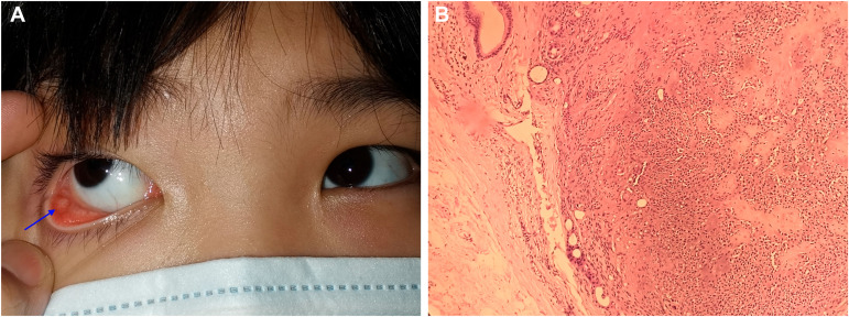 Pleomorphic Adenoma of the lower eyelid misdiagnosed as recurrent chalazion. Most of the pleomorphic adenomas arise from the lacrimal gland or the upper eyelid. #eyetwitter ow.ly/uzL150QK5ag