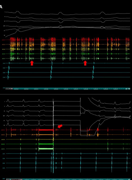 We recently had a patient with a lobe-disk LAAO device whose LSPV couldn’t be isolated with PFA in flower due to electromagnetic interference, despite multiple cath repositioning. What is your experience? @natale_md @jongichun @SergeBoveda @BorisSchmidt5 heartrhythmjournal.com/article/S1547-…