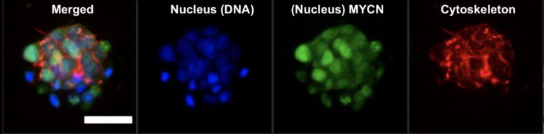 Cancer Bioengineering Group (@cancerbioengrg) on Twitter photo PI <a href="/0lgaPiskareva/">Olga Piskareva</a> #SnippetsOfScience this week painting a picture of the cell and its compartments🎨We can even light up mini #neuroblastoma tumours (called organoids) pictured below👇🏼Find out how Olga did this on a <a href="/Fulbright_Eire/">Fulbright Ireland</a> at <a href="/JohnsHopkins/">Johns Hopkins University</a> ➡️neuroblastomablog.com PI <a href="/0lgaPiskareva/">Olga Piskareva</a> #SnippetsOfScience this week painting a picture of the cell and its compartments🎨We can even light up mini #neuroblastoma tumours (called organoids) pictured below👇🏼Find out how Olga did this on a <a href="/Fulbright_Eire/">Fulbright Ireland</a> at <a href="/JohnsHopkins/">Johns Hopkins University</a> ➡️neuroblastomablog.com
