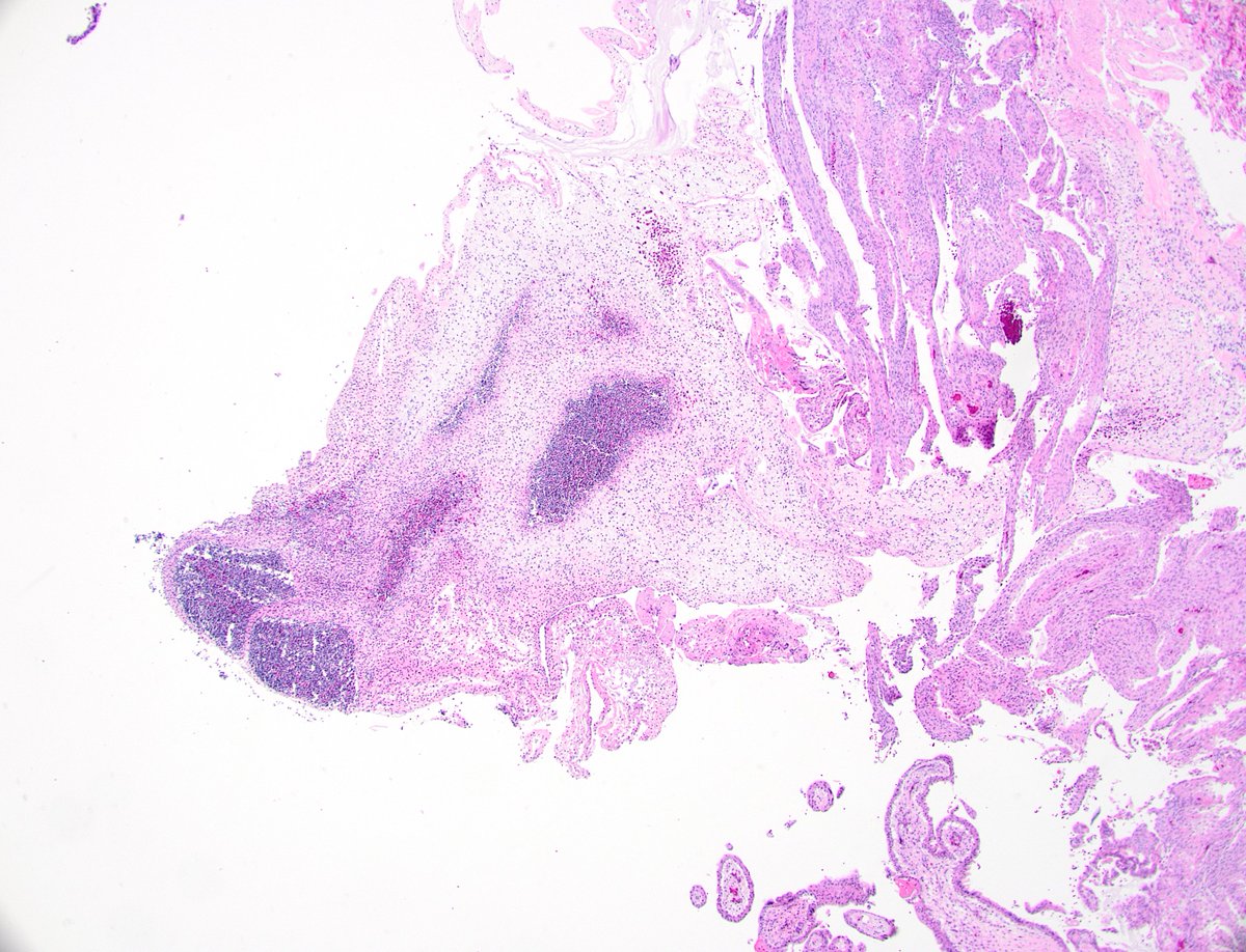 dgbrackett's tweet photo. POC, demise @ 7 weeks
Possible embryonic tissue or early umbilical cord?๐คทโโ๏ธ
#obpath #placentapath https://t.co/QwqUrZXk2X
