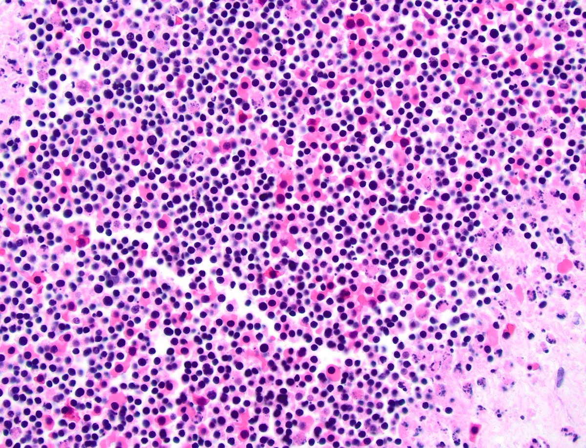 dgbrackett's tweet photo. POC, demise @ 7 weeks
Possible embryonic tissue or early umbilical cord?๐คทโโ๏ธ
#obpath #placentapath https://t.co/QwqUrZXk2X