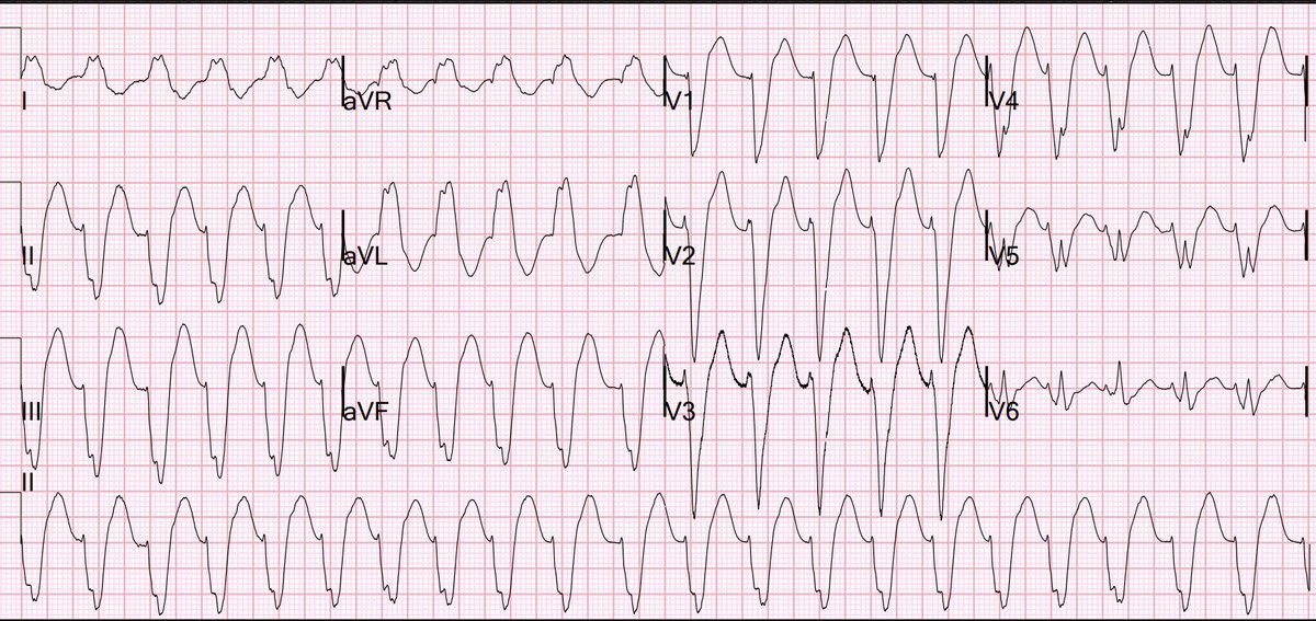 Ventricular Fibrillation, ICD, LBBB, QRS of 210 ms, Positive Smith Modified Sgarbossa Criteria, and Pacemaker-Mediated Tachycardia hqmeded-ecg.blogspot.com/2024/04/ventri…