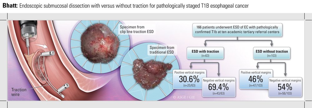ESD is better with traction 💪 Not only for efficiency but maybe oncologic outcomes as well. Our multi-center results of ESD with and without traction for T1b esophageal cancer. Thanks @AbelJosephMD @kornpongv @PrasadIyerMD and all co-authors for their collaboration!
