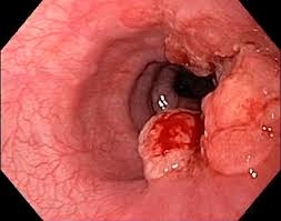Gazal6849's tweet photo. 🟣𝘾𝙇𝙄𝙉𝙄𝘾𝘼𝙇 𝙎𝘾𝙀𝙉𝙀𝙍𝙄𝙊:-
📝A 50yr old♂️p/w progressive #dysphagia for solids followed by liquids.He has a known case of #Barrets esophagus.
1st line #diagnostic test❓
A) Stool Microscopy
B) Upper GI Endoscopy & Biopsy
C) Barium Swallow
#medx https://t.co/naA0zJp7bn