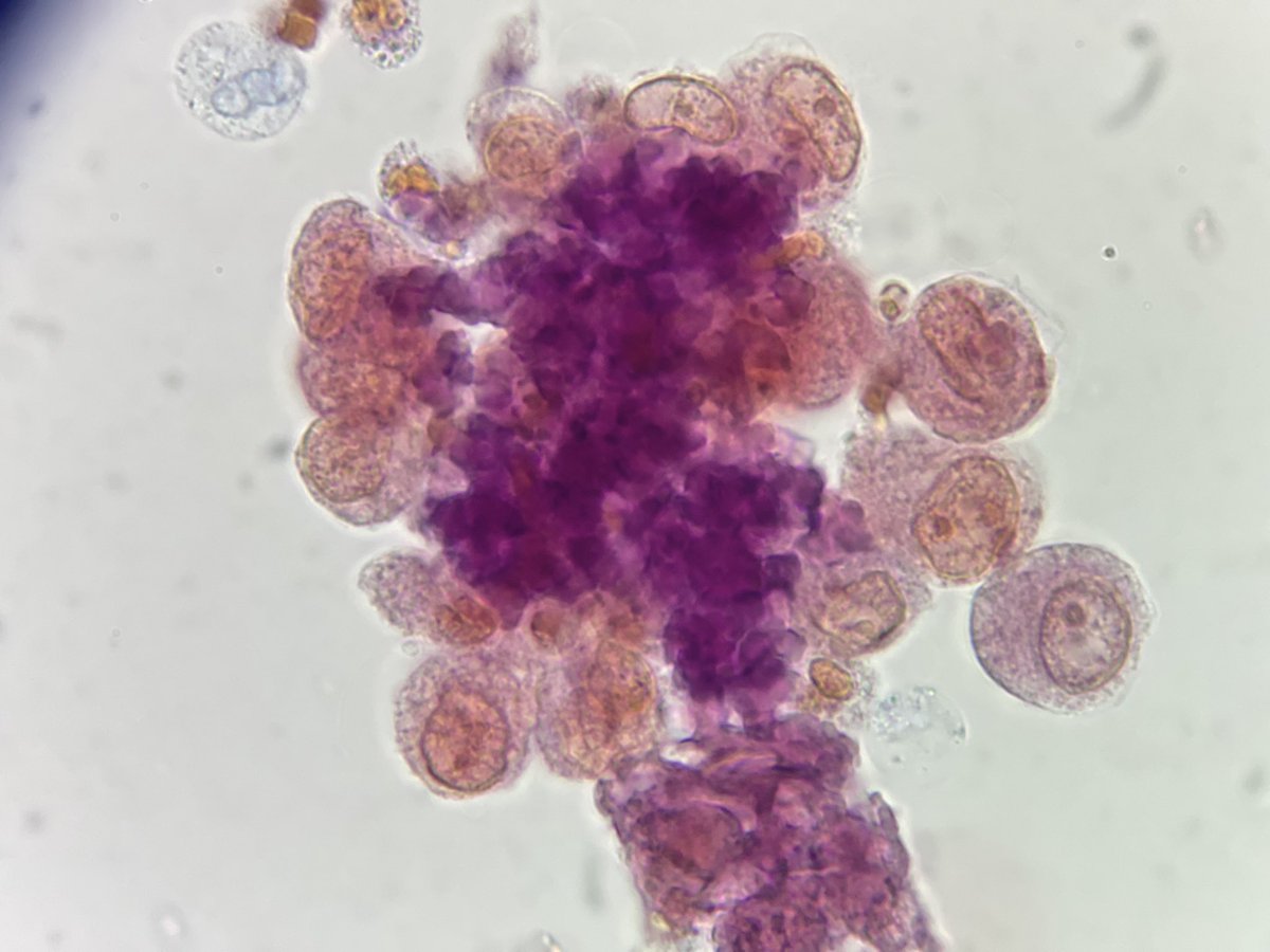 Células de túbulo renal "desbordando" en cilindros granulares. Paciente con ERC.

📷 Microscopia de campo claro 1000x. Tinción Sternheimer y Sternheimer-Malbin