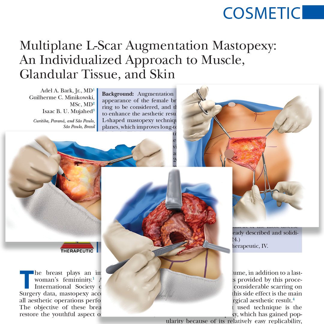 In this #PRSJournal article, the authors aim to describe a variation of the L-shaped #mastopexy technique without complex marking and performed in planes, which improves long-term results for patients undergoing this approach. Read it: bit.ly/LScarMastopexy